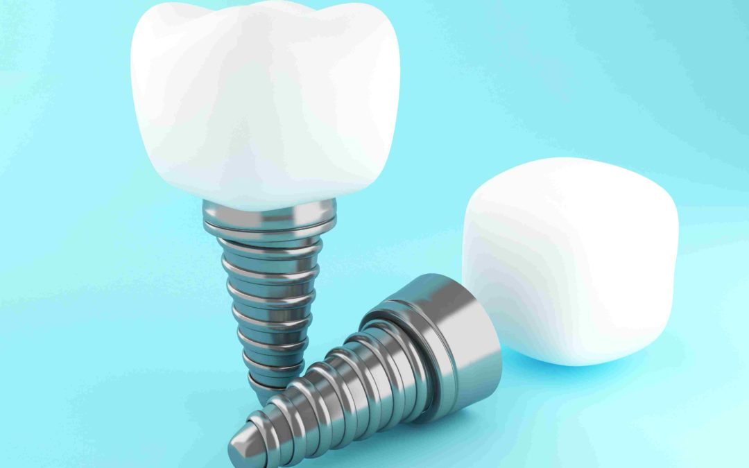 ¿Cuáles son las etapas y el proceso de colocación de un implante dental?